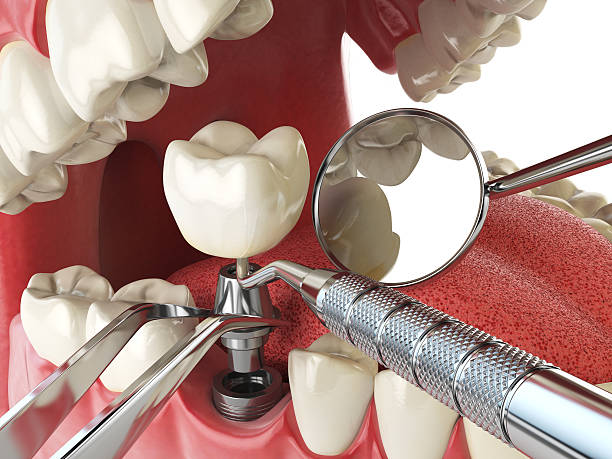 Best Emergency Tooth Extraction in Jackson Center, OH